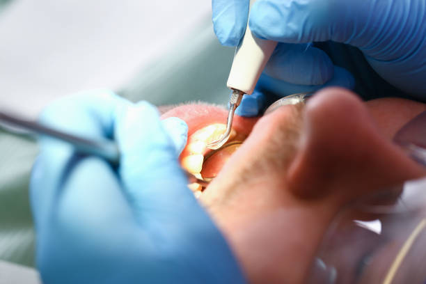 Best Emergency Tooth Extraction in Shoshone, ID
